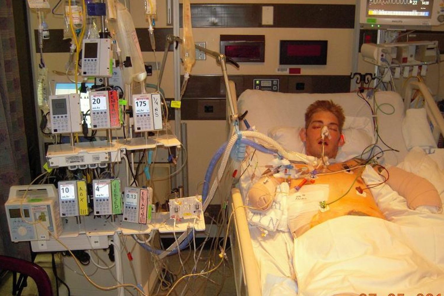 The First Blast Took His Memory. The Second Took His Limbs. Why This Marine Is Still Fighting