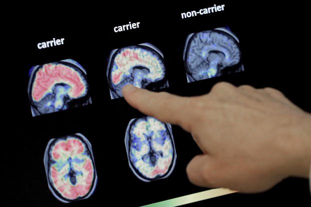 Doctor looks at PET brain scan at the Banner Alzheimers Institute.